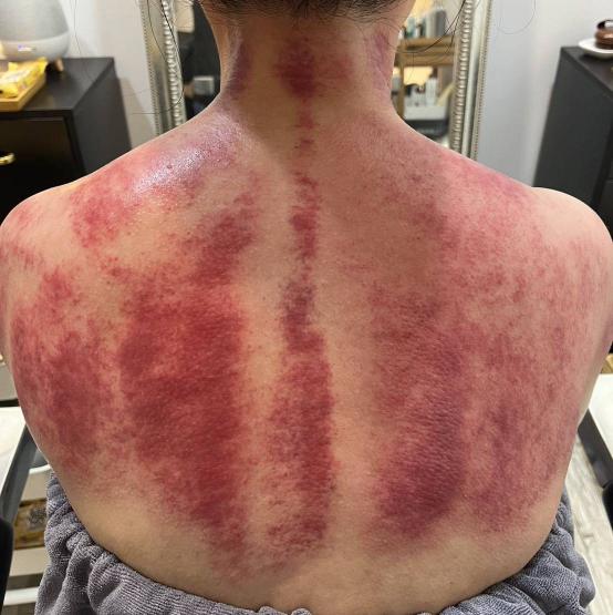 新竹竹北｜洗髮頭療｜每週一三五